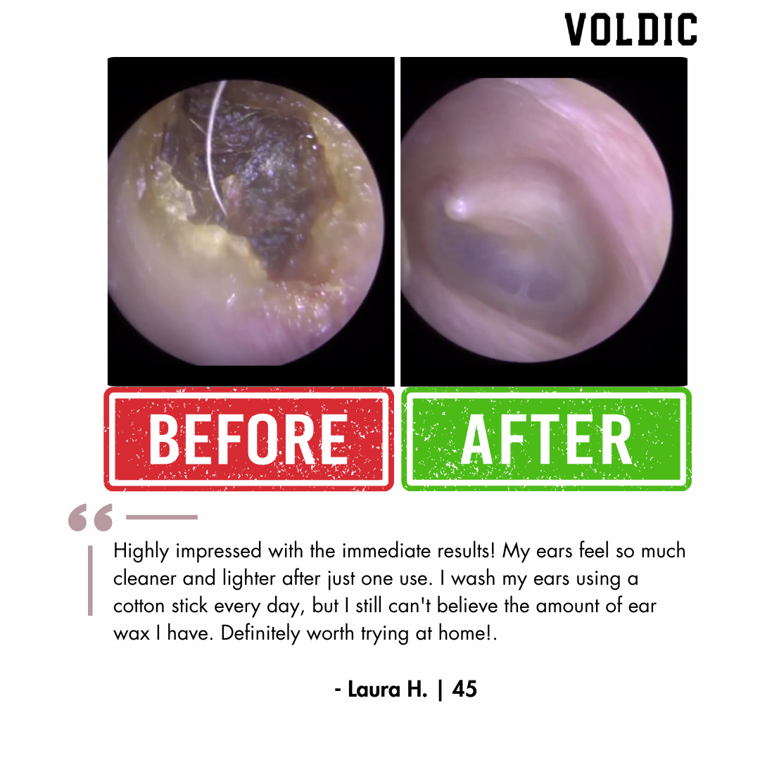 Voldic™ Electric Ear Wax Removal Kit